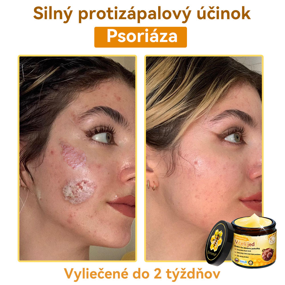 [💯 Bez bolesti-bez vedľajších účinkov] 𝐃𝐨𝐫𝐦𝐨𝐫𝐧𝐚®💥💥𝐕č𝐞𝐥í 𝐣𝐞𝐝 𝐊𝐫é𝐦 𝐧𝐚 𝐨𝐛𝐧𝐨𝐯𝐮 𝐩𝐨𝐤𝐨ž𝐤𝐲- POSLEDNÝ DEŇ 70% VYPNUTIE