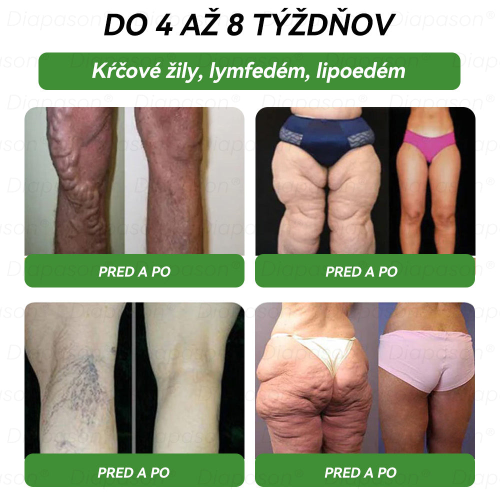 🔥𝑂𝑓𝑖𝑐𝑖á𝑙𝑛𝑦 𝑜𝑏𝑐ℎ𝑜𝑑 | 𝐃𝓲ａ𝓹𝓪𝓼𝐨𝓷 ® Ｇ𝖫𝑃-𝟏 𝑆𝑒𝑑𝑒𝑚 𝑣 𝑗𝑒𝑑𝑛𝑜𝑚 𝑃𝑒𝑟𝑜𝑟á𝑙𝑛𝑦 𝑟𝑜𝑧𝑡𝑜𝑘 𝑝𝑟𝑒 𝑧𝑑𝑟𝑎𝑣𝑖𝑒 - Obezita, kardiovaskulárne ochorenia, cukrovka, spánkové dýchanie, problémy s kĺbmi a ďalšie